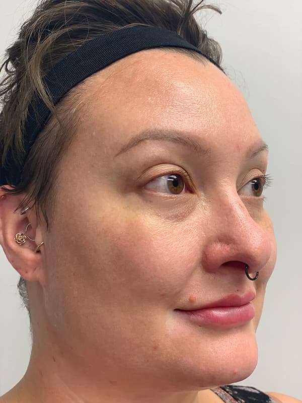 Halo Laser After - Patient 93898058 - Front Right View