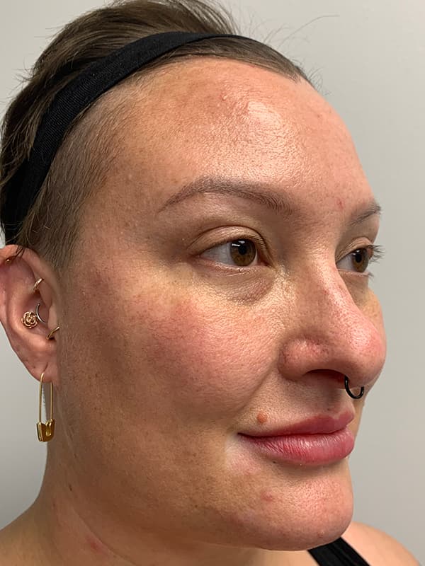 Halo Laser Before - Patient 93898058 - Front Right View