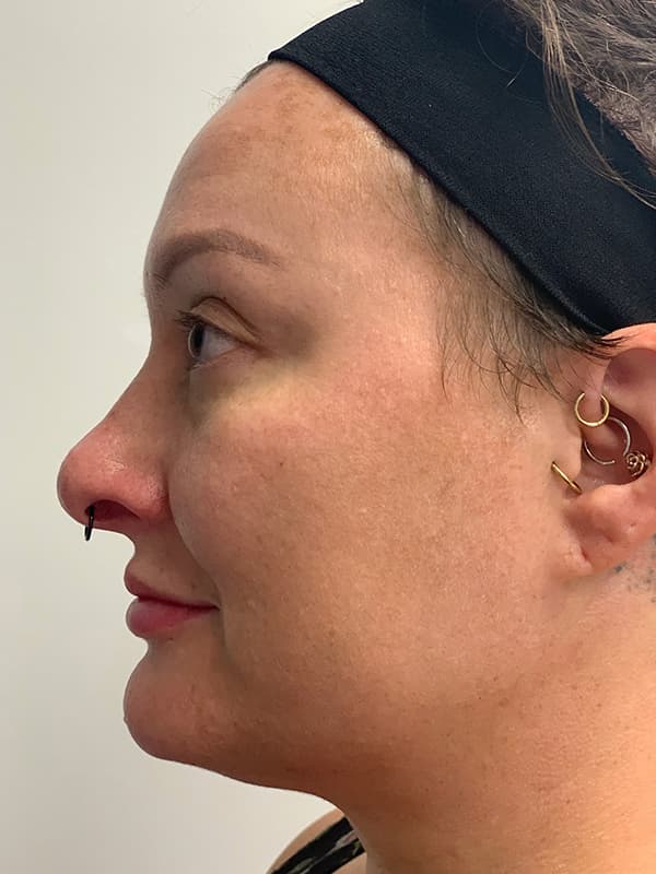 Halo Laser After - Patient 93898058 - Left View