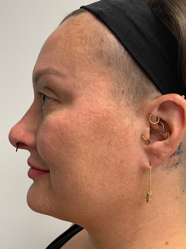 Halo Laser Before - Patient 93898058 - Left View