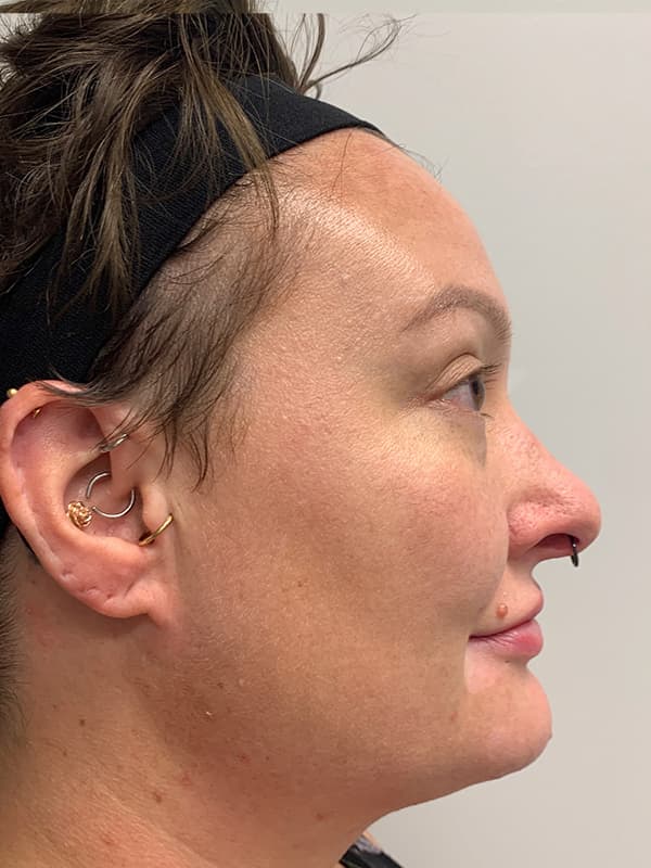 Halo Laser After - Patient 93898058 - Right View