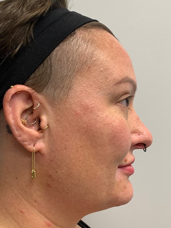 Halo Laser Before - Patient 93898058 - Right View