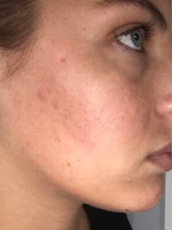 Halo Laser After - Patient 93898077 - Front Right View