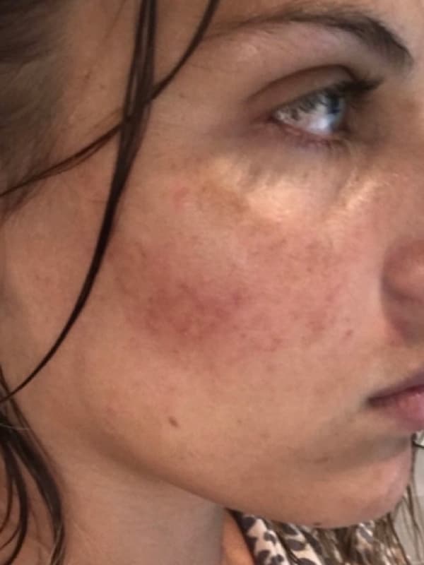 Halo Laser Before - Patient 93898077 - Front Right View