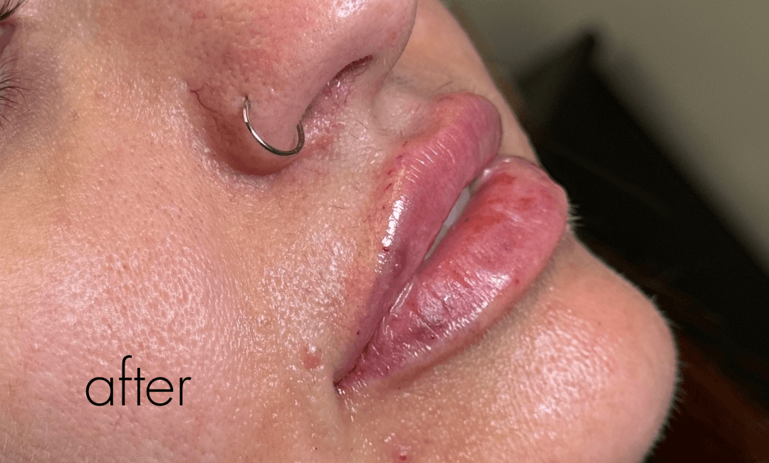 Halo Laser After - Patient 176764 - Front Right View