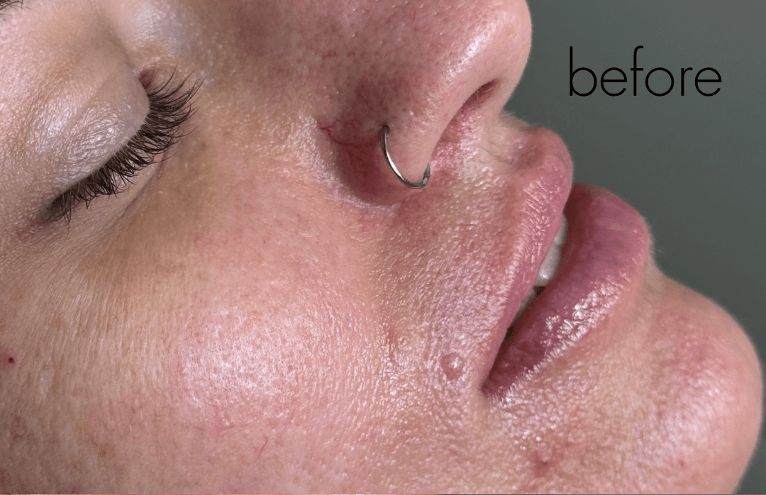 Halo Laser Before - Patient 176764 - Front Right View