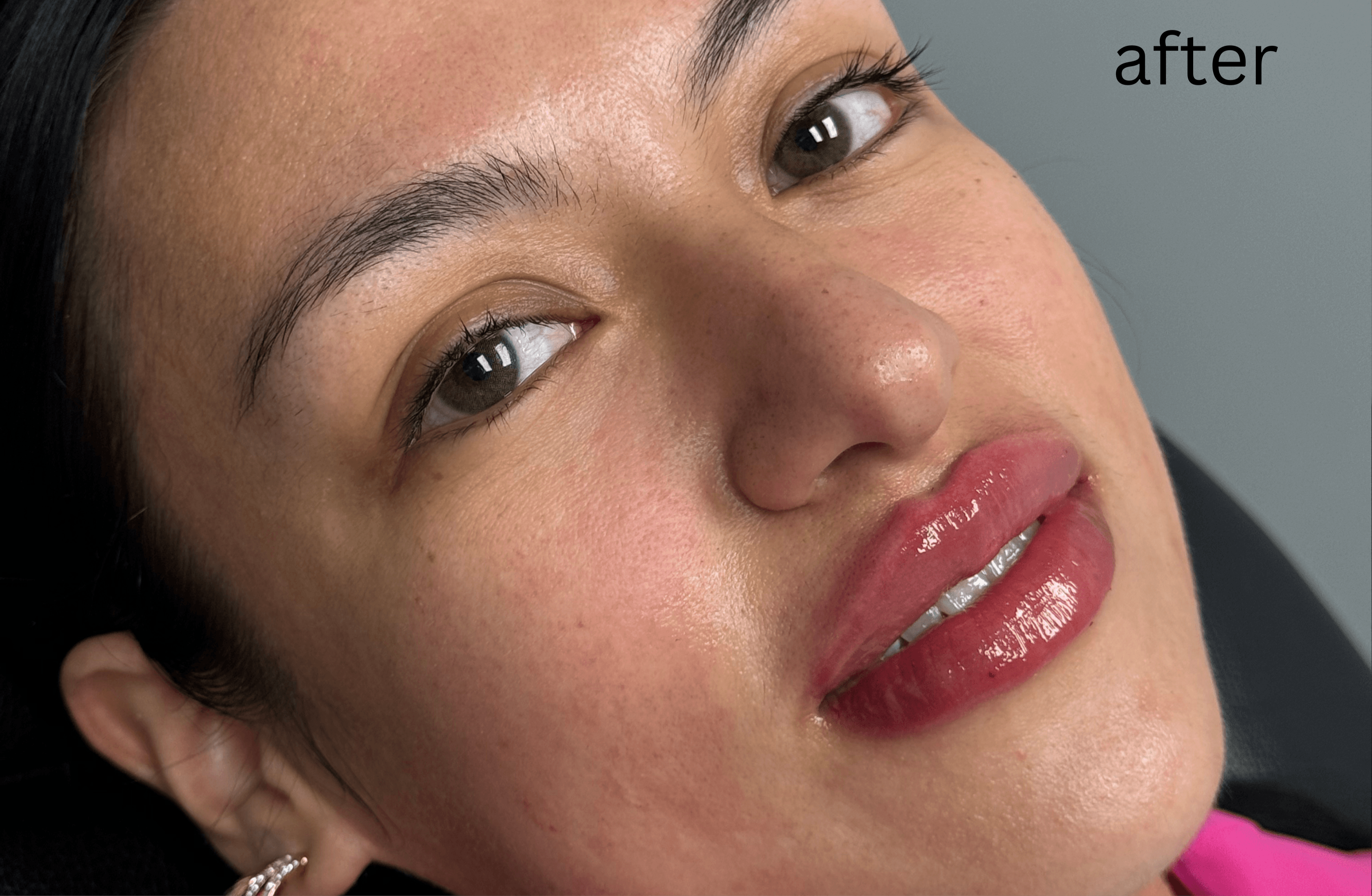 Halo Laser After - Patient 178757 - Front View