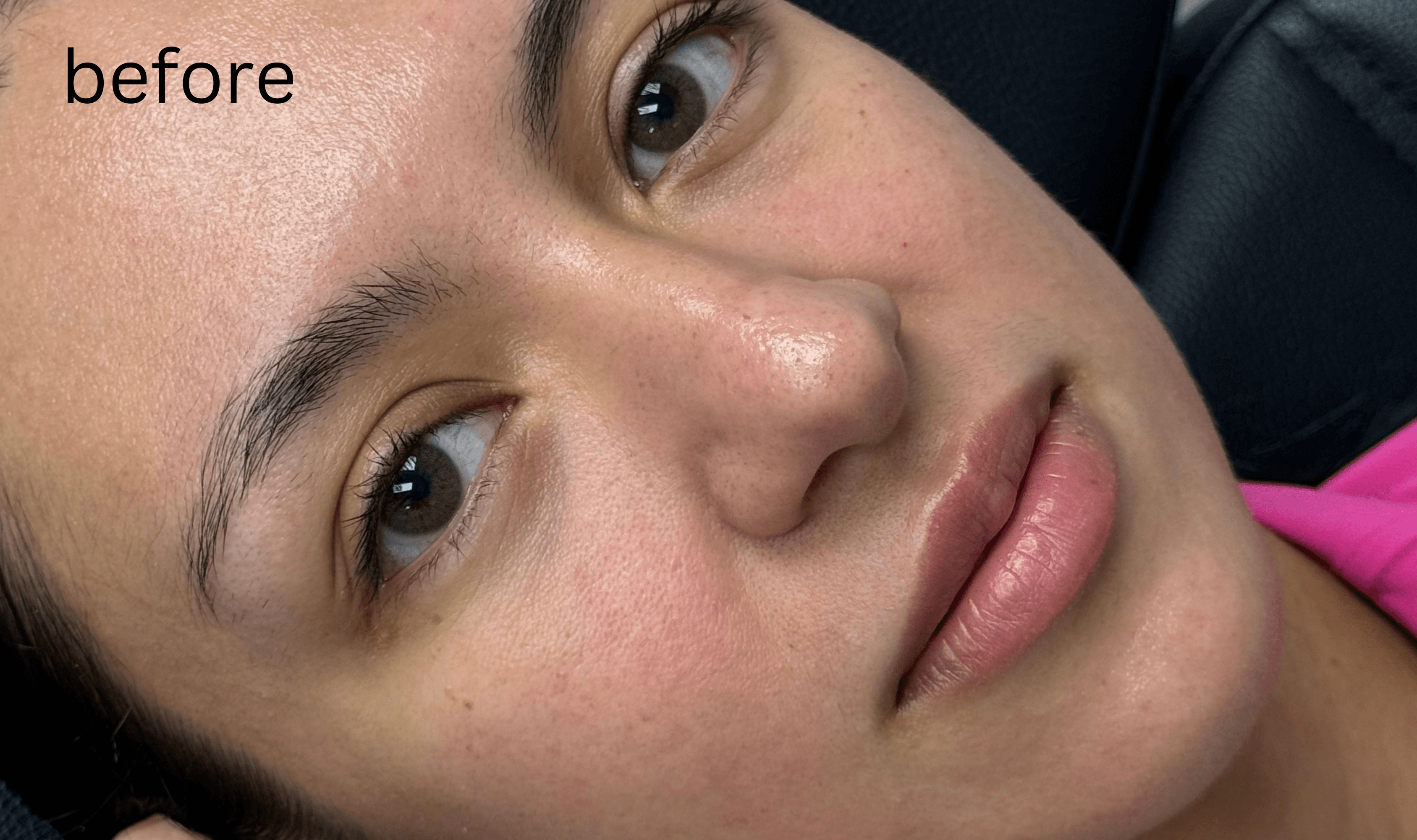 Halo Laser Before - Patient 178757 - Front View