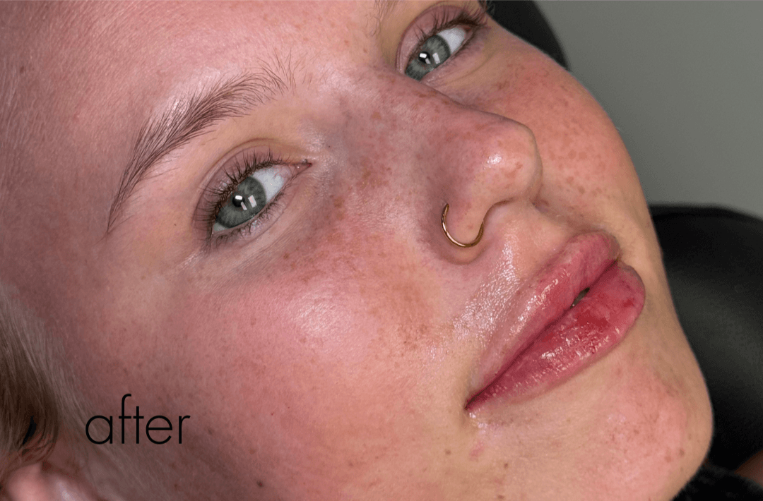 Halo Laser After - Patient 326437 - Front Right View