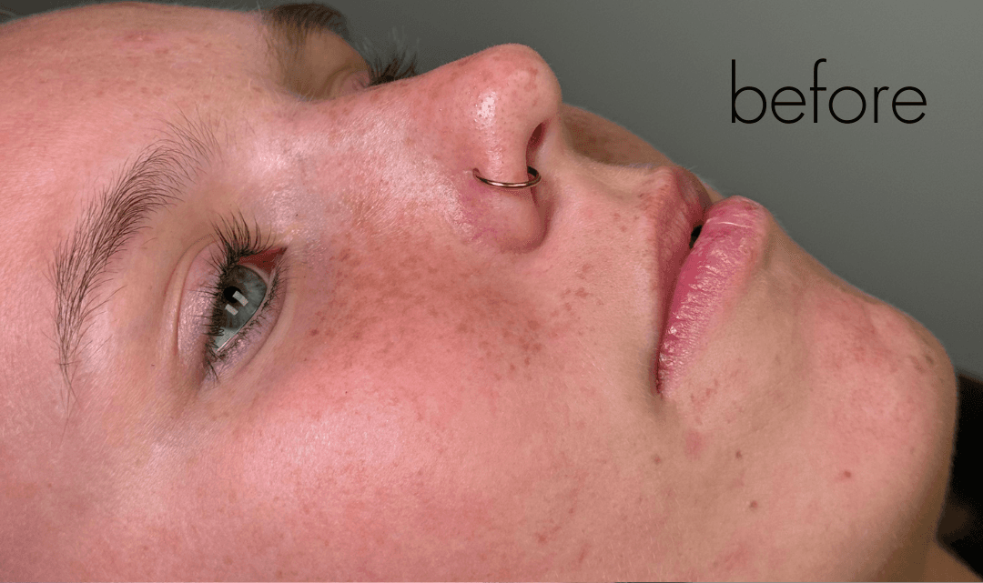 Halo Laser Before - Patient 326437 - Front Right View