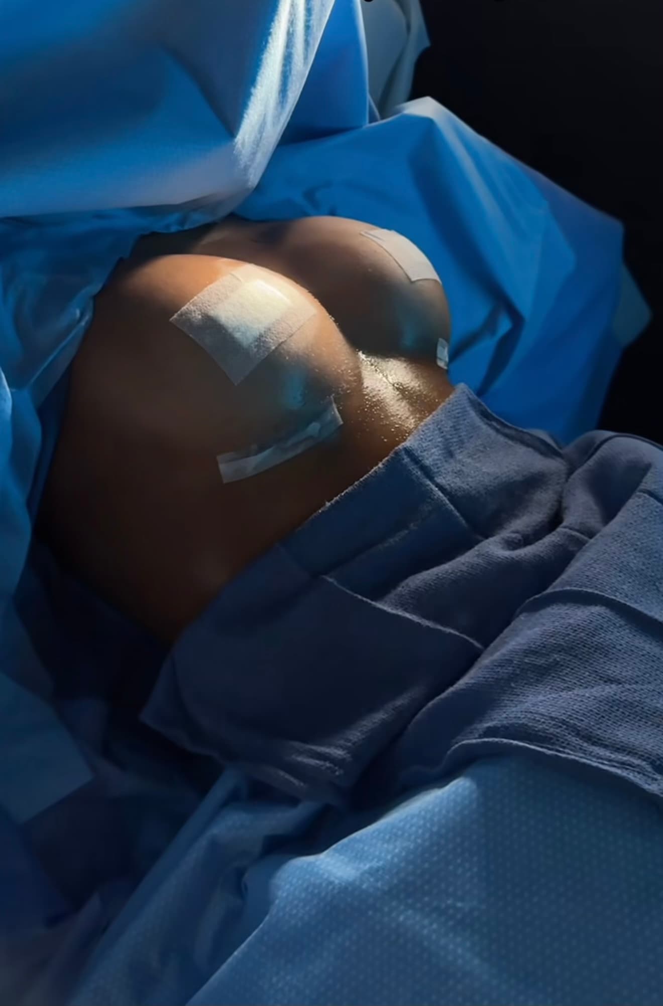 Breast augmentation results