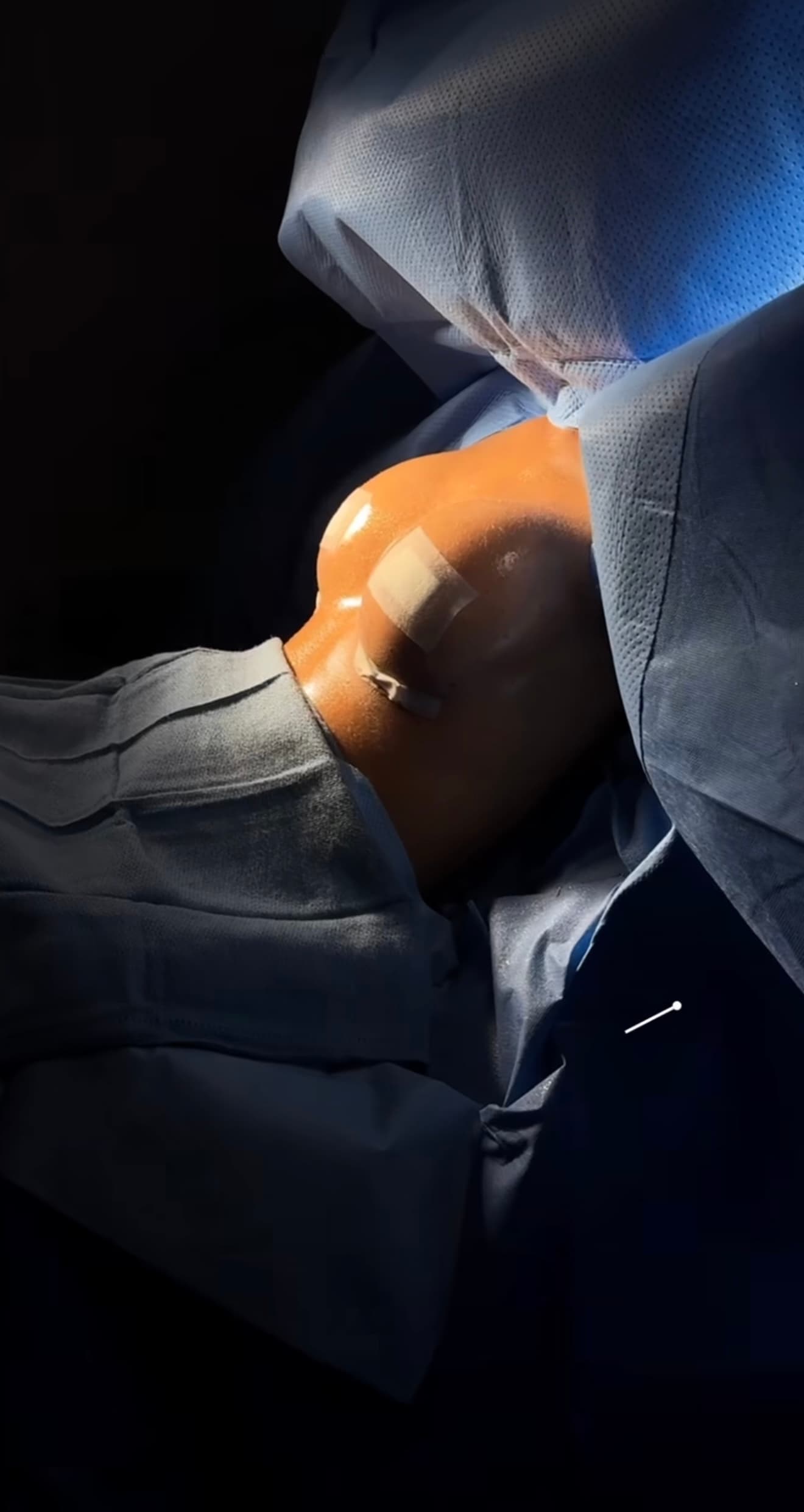 Breast Surgery