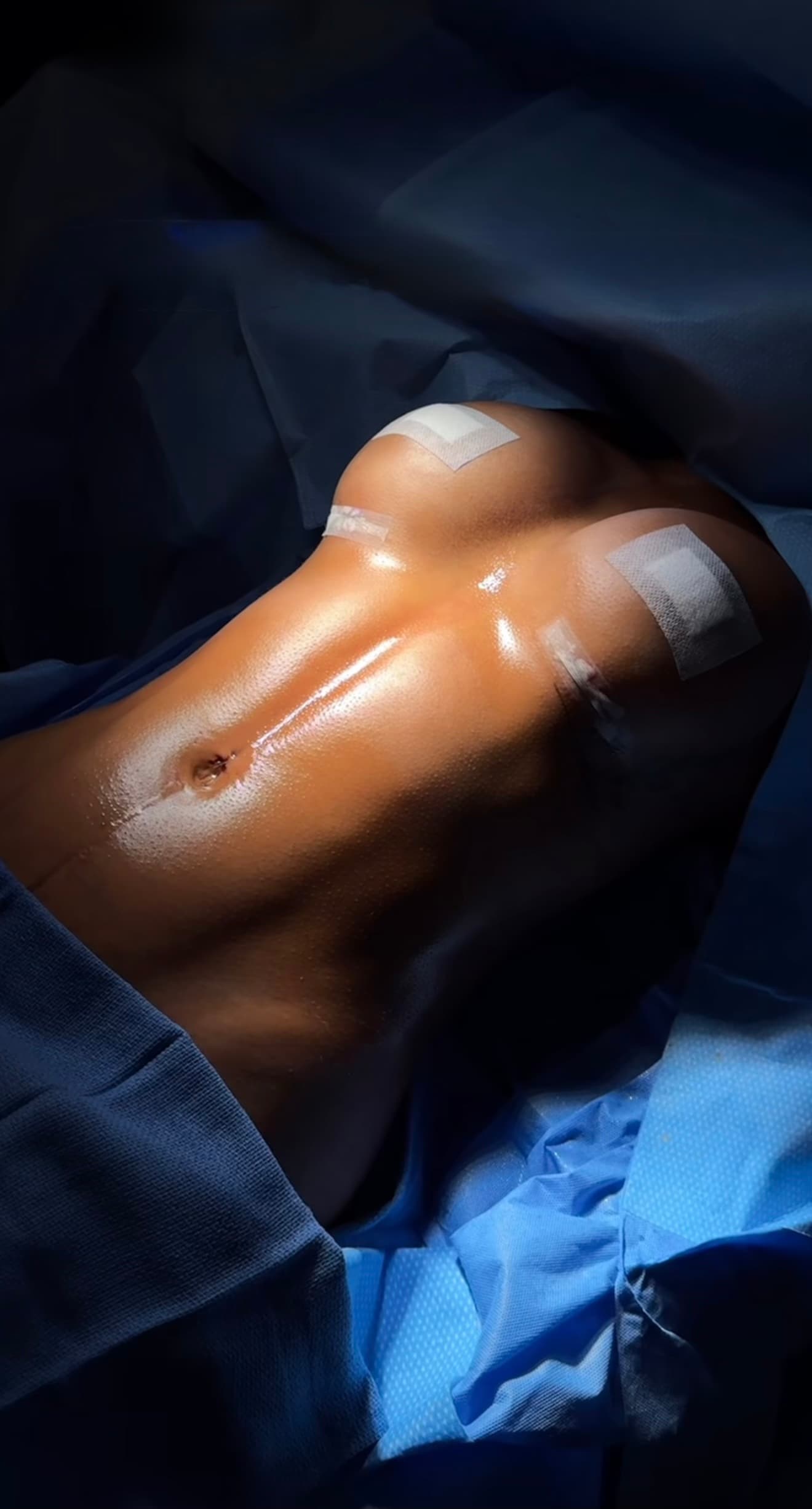 Natural / Cali Boob Job (Fat Transfer to Breasts)