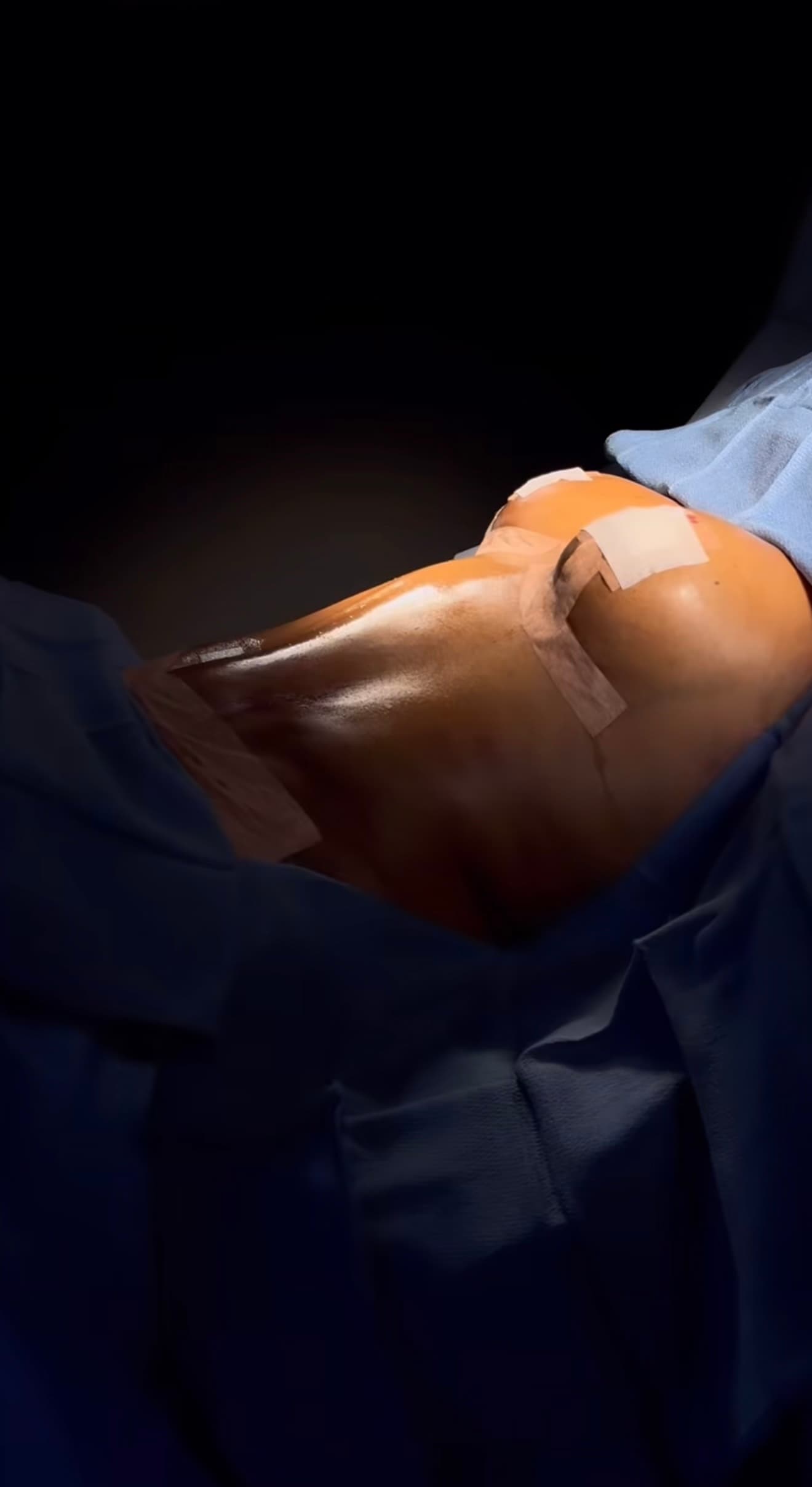 Breast Revision / Breast Asymmetry Correction