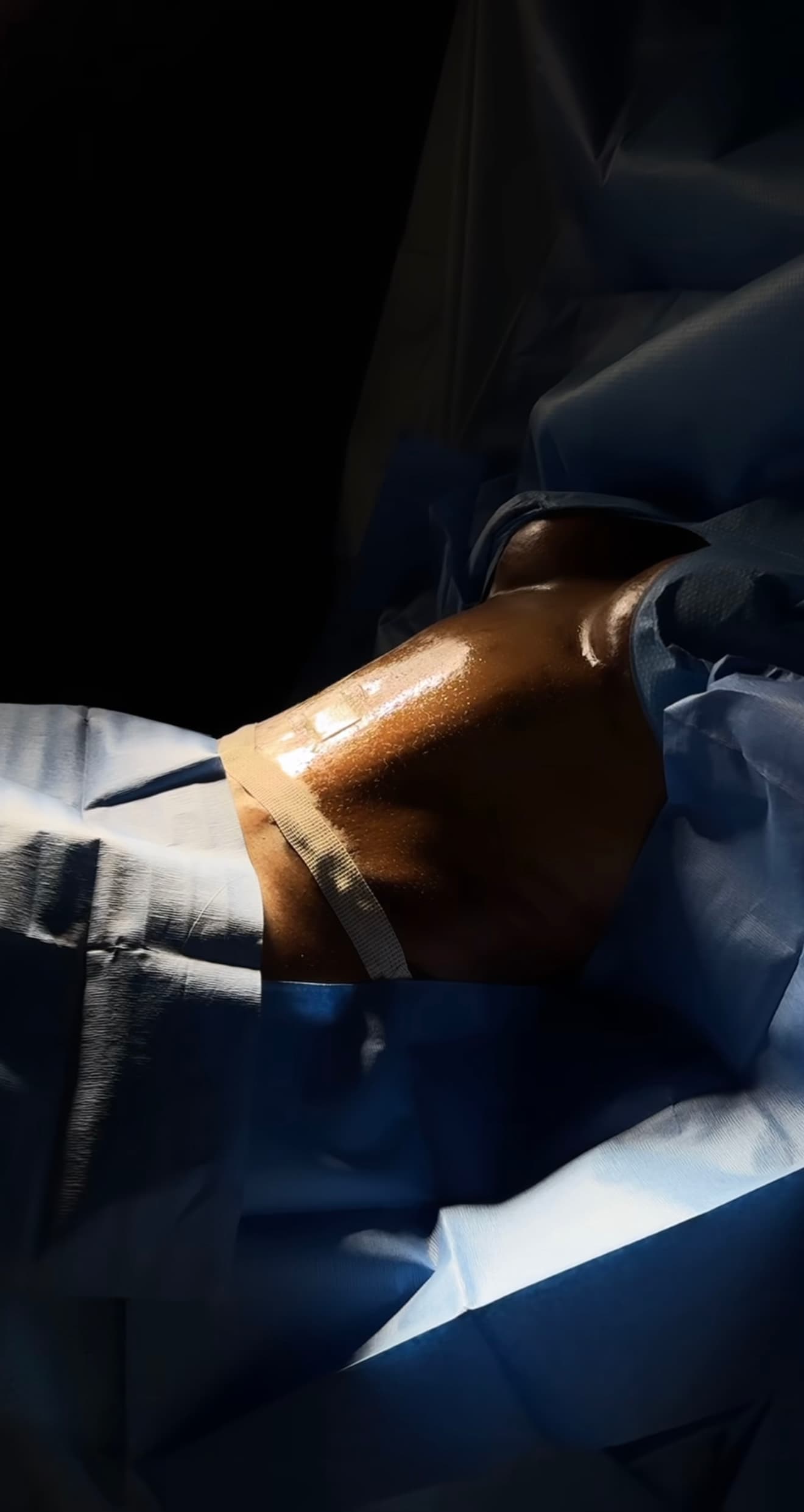 Donut Lift (Periareolar Mastopexy)