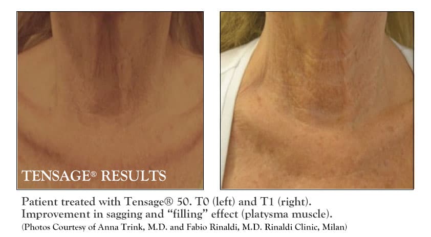 Biopelle Tensage Serum Before & After