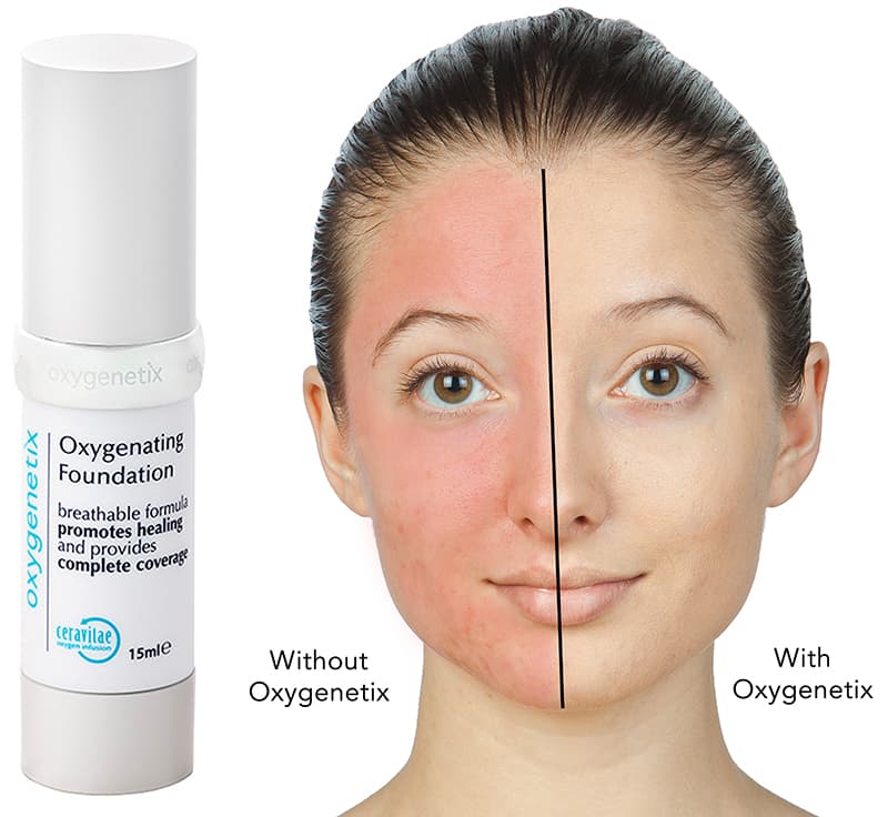 Oxygenetix Before & After 1