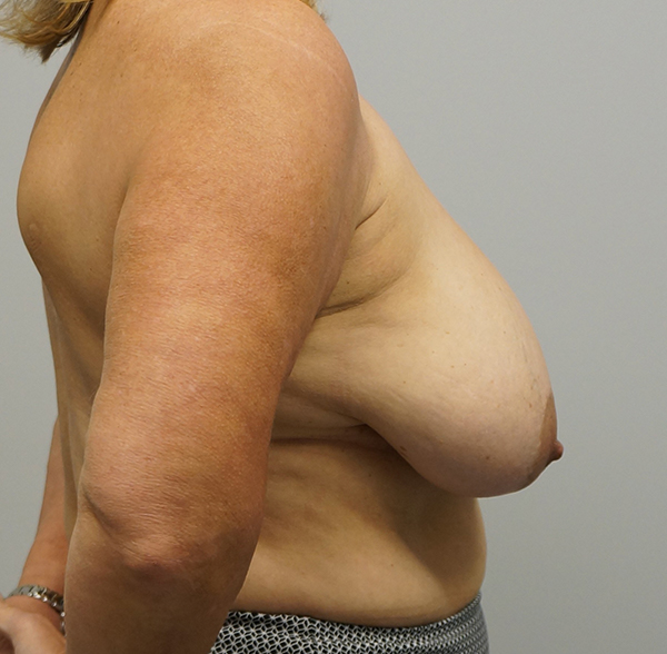 Before breast reduction in Houston