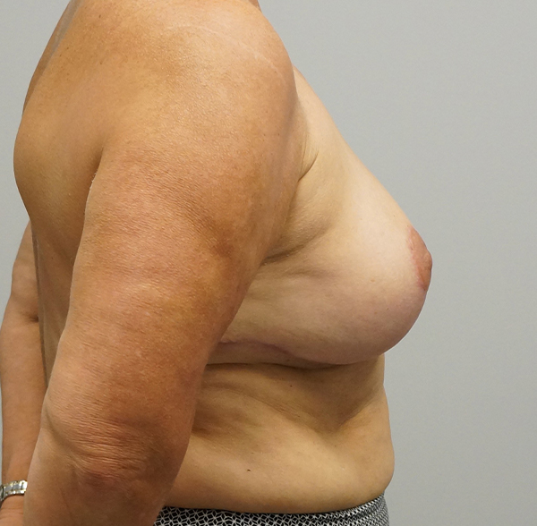 After breast reduction in Houston
