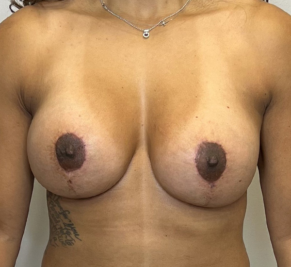 Breast Revision Before & After Gallery - Patient 93887957 - Image 2