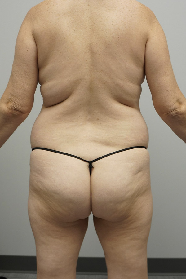 Liposuction Before & After Gallery - Patient 93898860 - Image 1