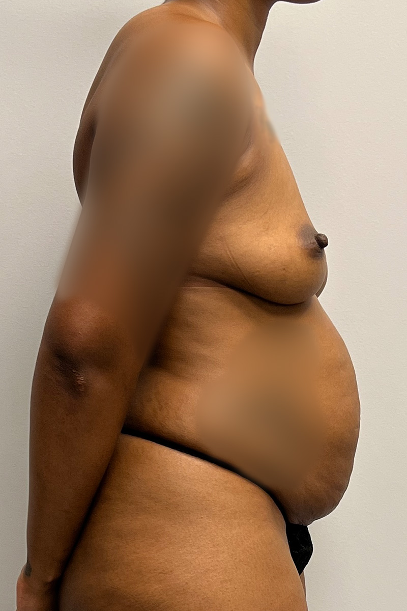 Tummy Tuck Before & After Gallery - Patient 330160 - Image 9