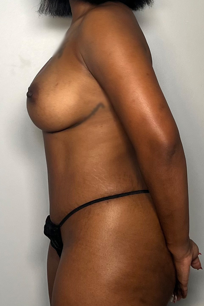 Tummy Tuck Before & After Gallery - Patient 330160 - Image 8