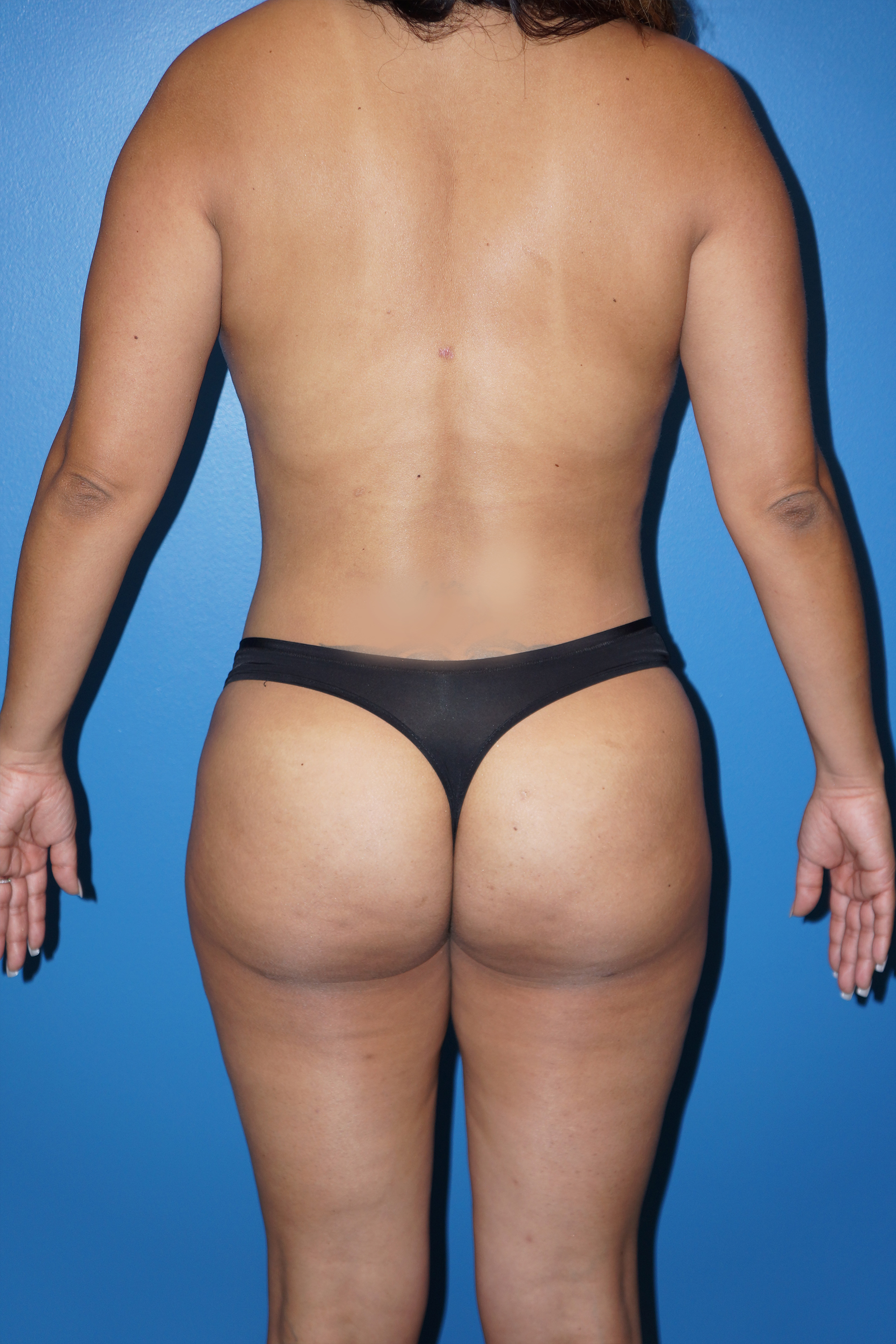 Patient 248321 Brazilian Butt Lift Gallery