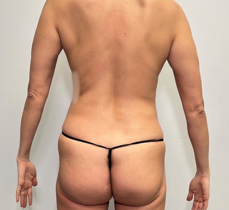 Patient 302927 Brazilian Butt Lift Gallery