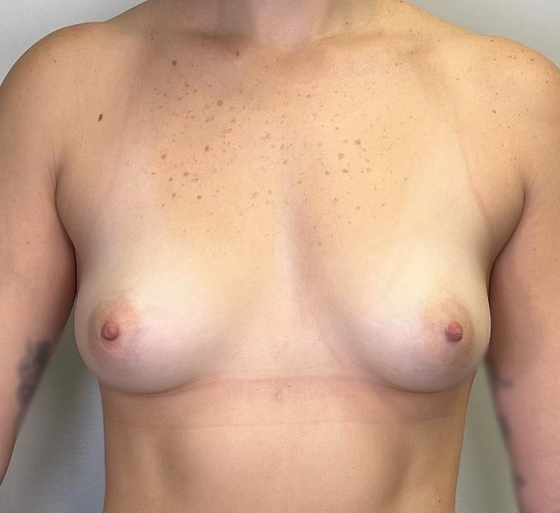 Breast Augmentation Before & After