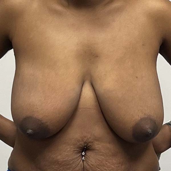Before breast reduction in Houston