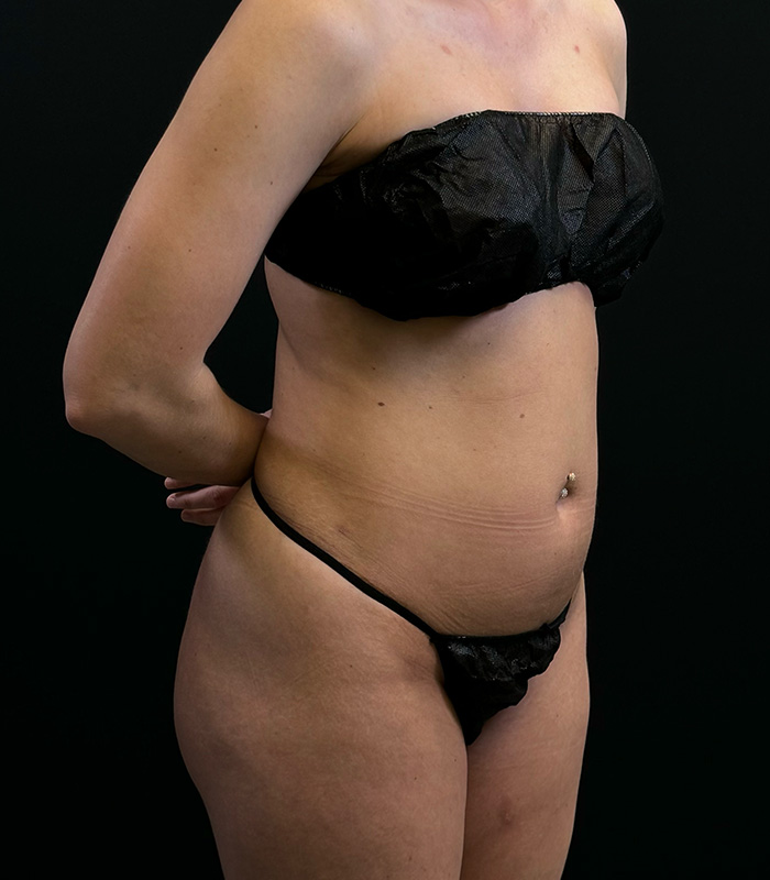 HD Liposuction 360  Before & After Gallery - Patient 354875 - Image 5